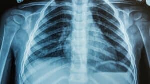 cette étude alerte certains aliments du quotidien pourraient nourrir silencieusement le cancer du poumon
